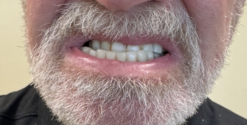 Before Before